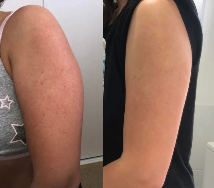 WhiteMoon® Strawberry Skin — KERA Crema Rejuvenecedora Triple Ácido