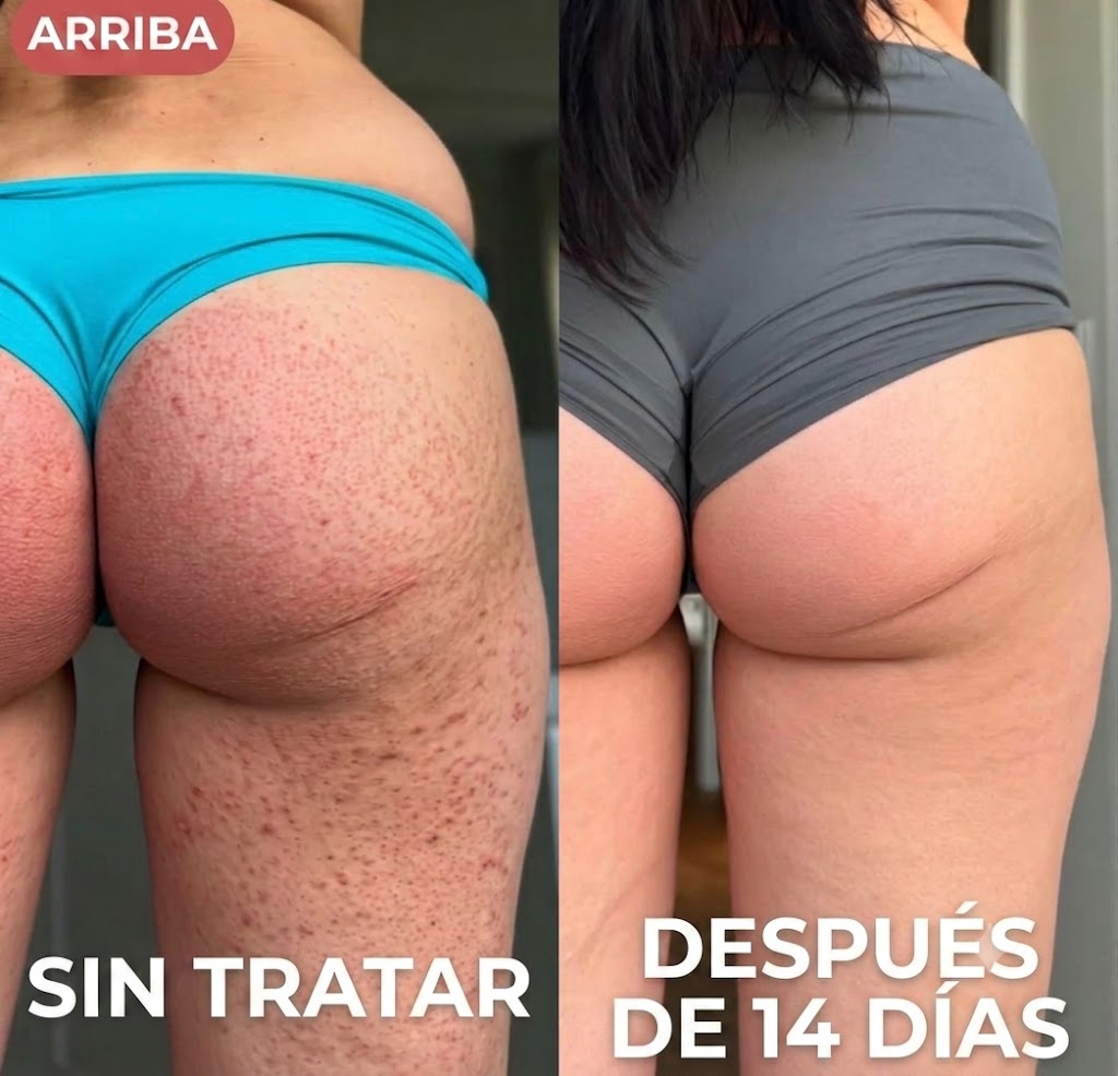 WhiteMoon® Strawberry Skin — KERA Crema Rejuvenecedora Triple Ácido